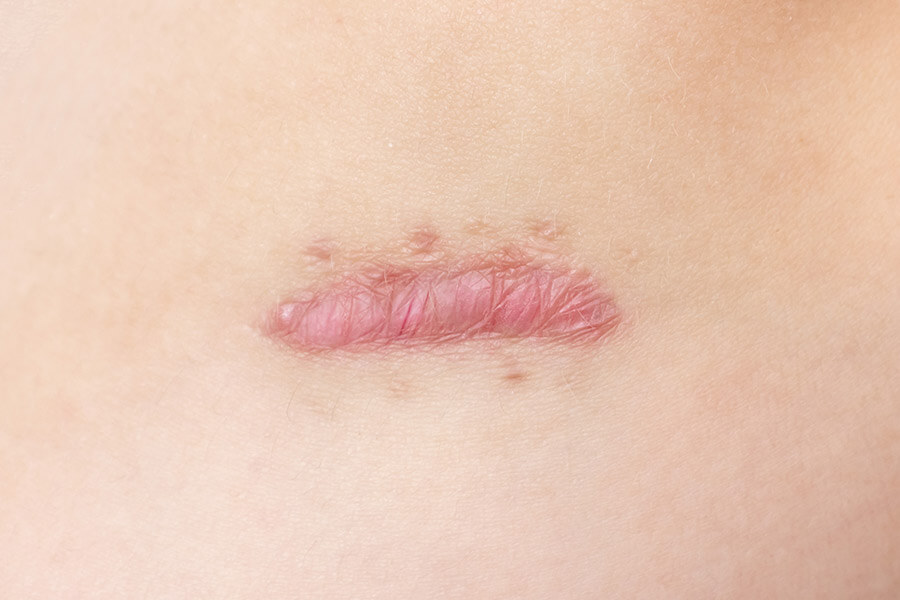 Close up of cyanotic keloid scar.