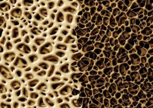bone with osteoporosis