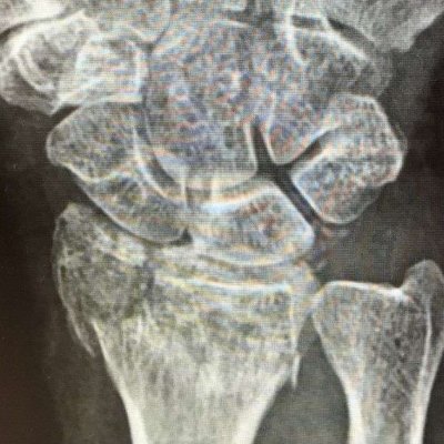 Distal-radius-fractures