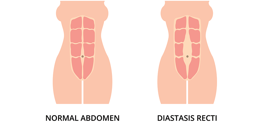 Diastasis Recti, Treatment, and Return to Exercise & Core Strength -  Proliance Surgeons